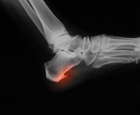 heel spur spur