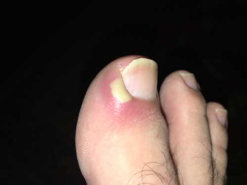 ingrown1 Ingrown1